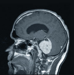 MRI of Brain - base of skull tumour